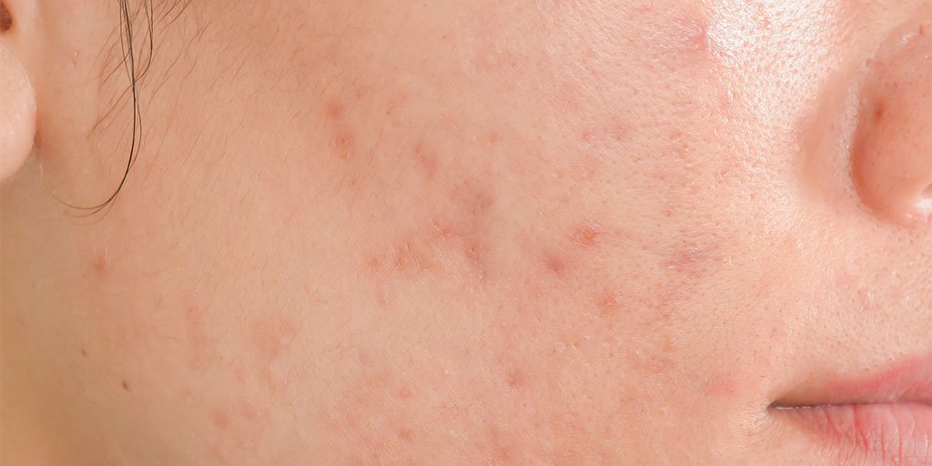 Acne Article - main image