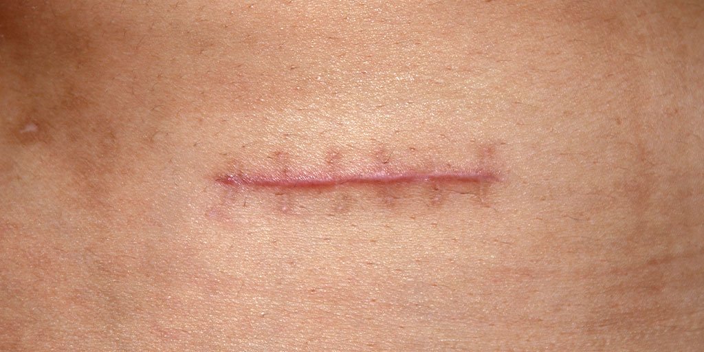 Acne Article - main image
