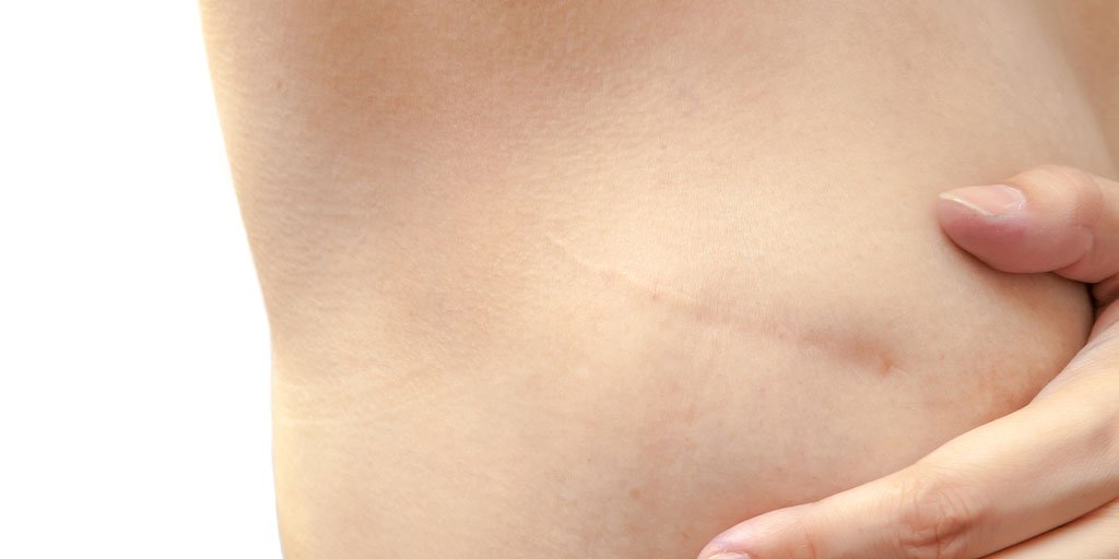 Acne Article - main image