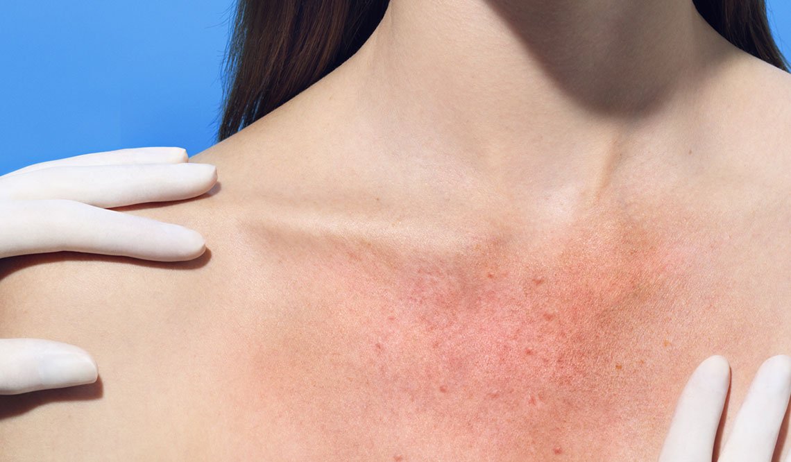 Larocheposay SubCategory Sun Sun sensitivity and sun reactions