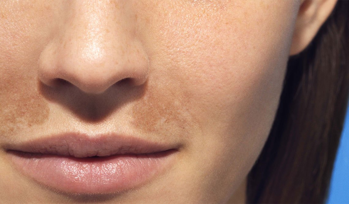 LarocheposaySubCategoryPageSunSunpigmentation